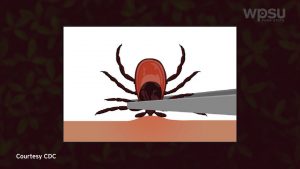 Illustration of tick removal